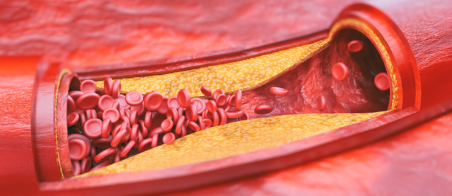 Blog | Washington Vascular