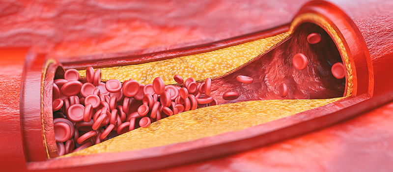 Peripheral Artery Disease | Washington Vascular