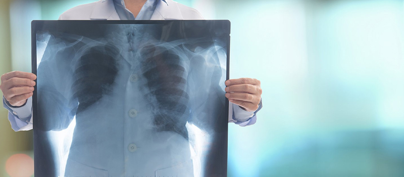 P Embolism Manage and Treat Washington Vascular