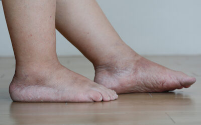 Uncovering the Vascular Causes of Leg Pain and Swelling